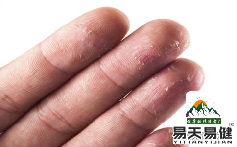 冬季容易手脱皮 4个因素所导致